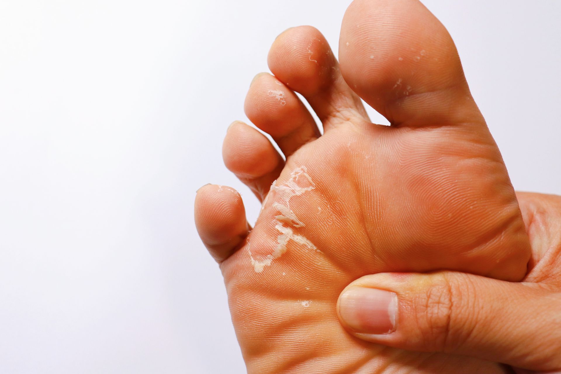 Athlete's Foot Treatment - Steady Foot Clinic