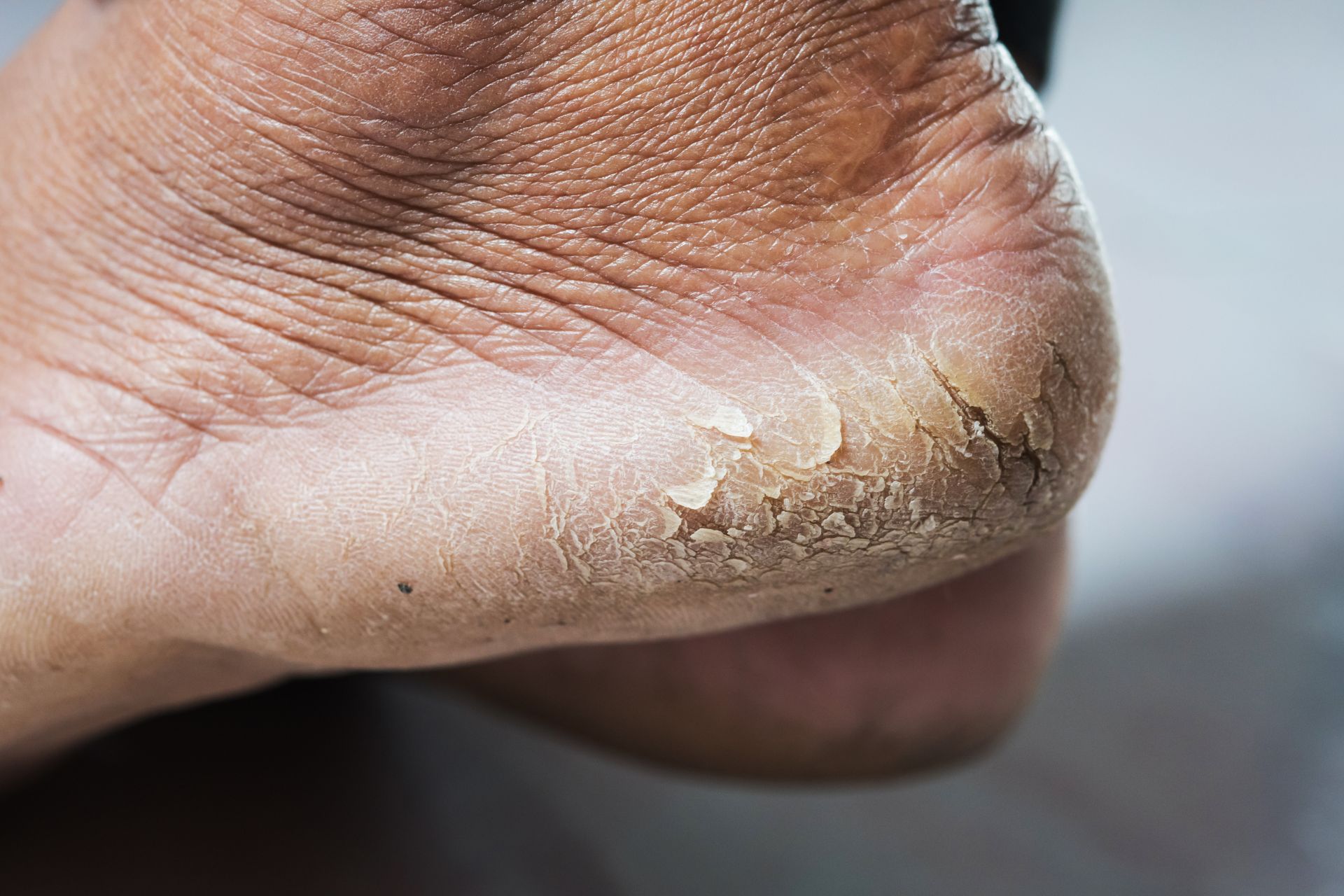 Cracked Heels Dry Skin Treatment Steady Foot Clinic