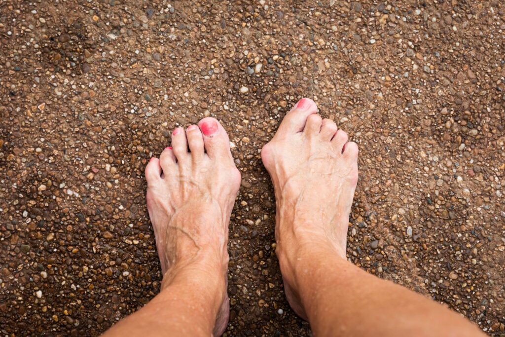 bunion treatment (hallux valgus) at steady foot clinic in north york