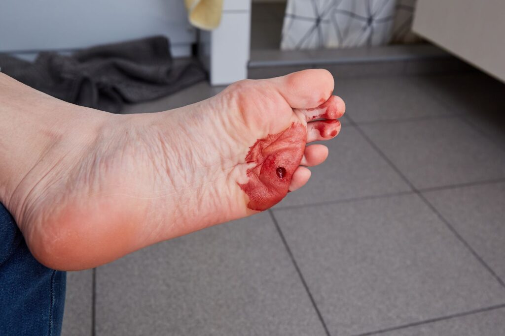 open wound treatment by steady foot clinic in north york