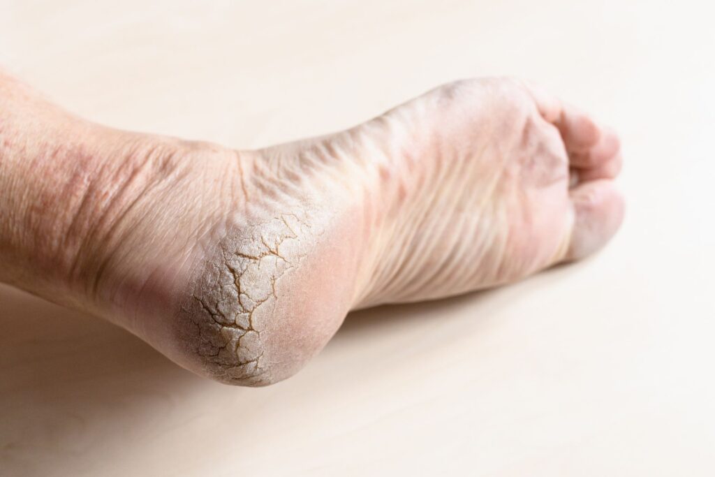 foot fissure treatment by steady foot clinic in north york