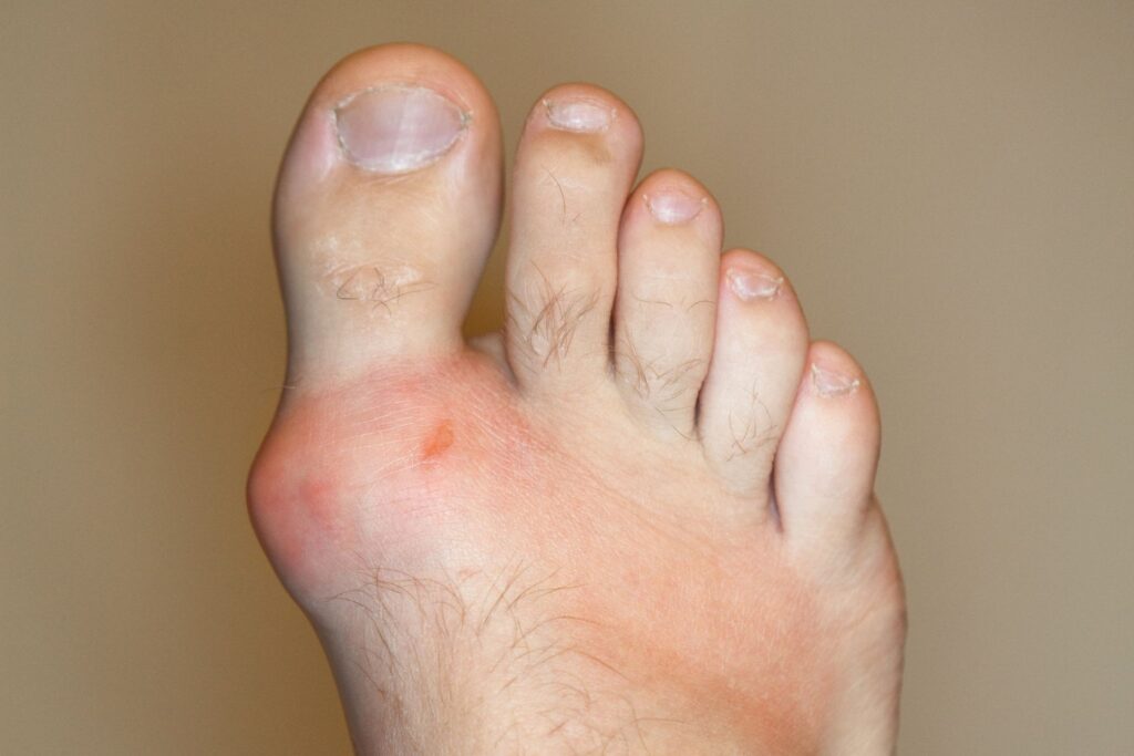 gout treatment by steady foot clinic in north york